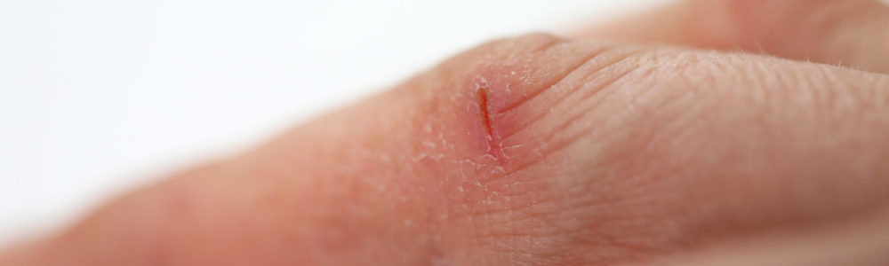 Close-up small wound on finger, dry skin hands. Skin loses moisture and becomes dry. Sensitivity decreases and risk infection increases. Sensitivity to external factors, easily blushes and peels