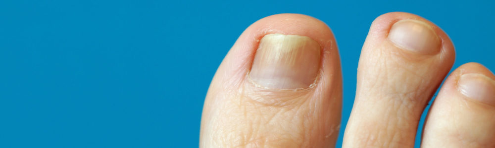 panoramic images of toe with nail psoriasis. A woman has an ingrown toenail. short cutted nails. Dermatitis. foot with nail psoriasis.